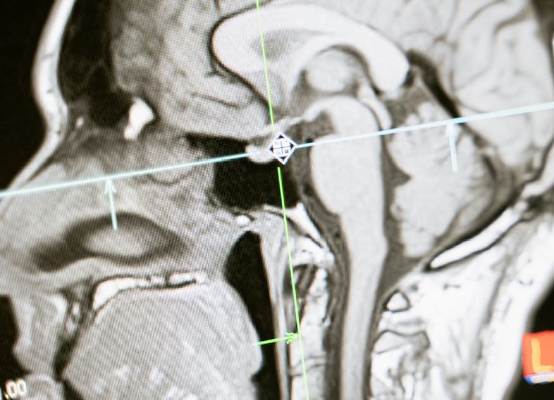 brain chip hybrid